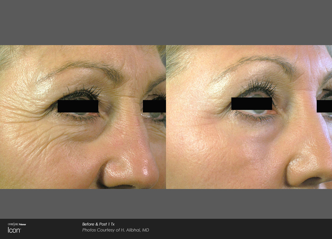 Skin Resurfacing Eugene OR Laser Skin Renewal Cascade Dermatology And Aesthetics