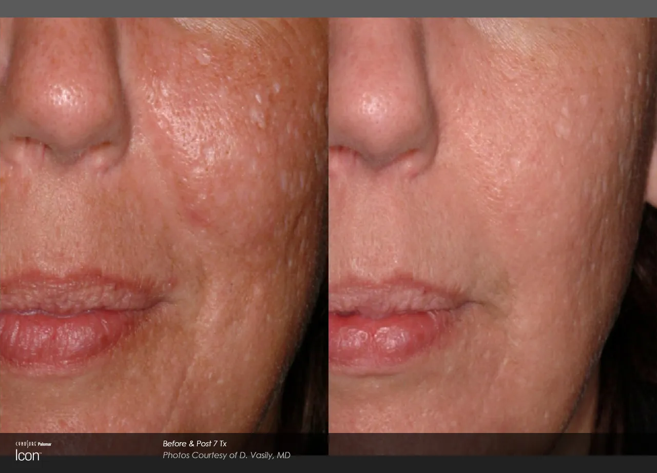 Laser 2024 scar removal