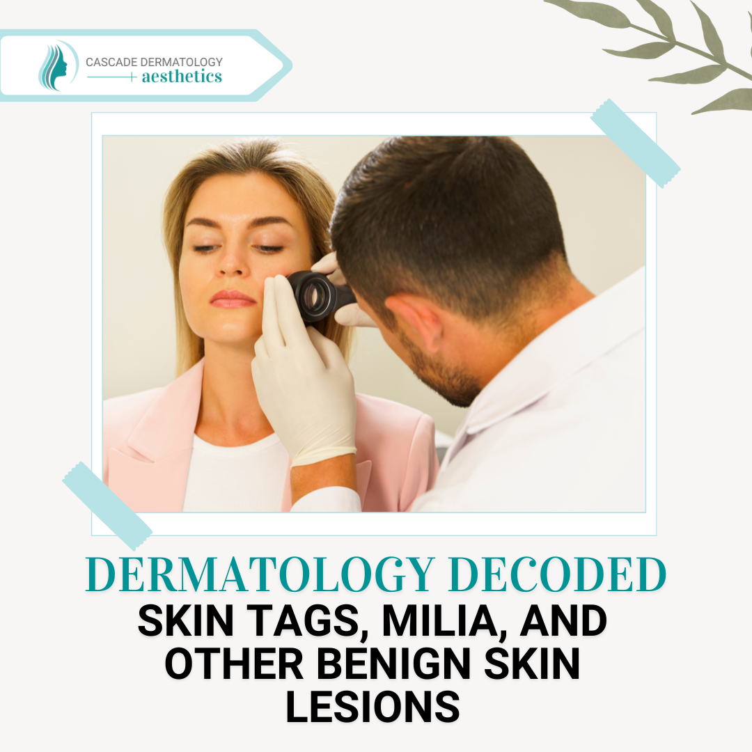 Dermatology Decoded: Skin Tags, Milia, and Other Benign Skin Lesions